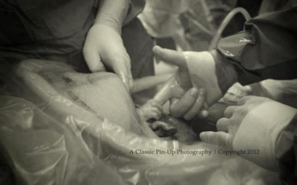 Μωρό αρπάζει το δάκτυλο του γιατρού τη στιγμή της γέννησης του