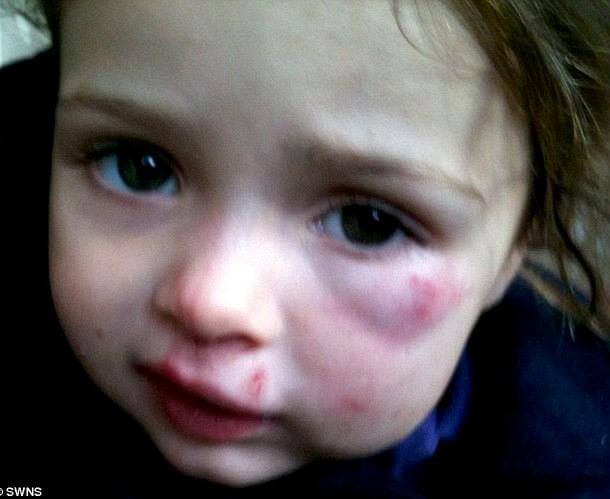 2 Δείτε πώς είναι σήμερα η πεντάχρονη Katie Ann Guttridge