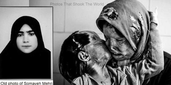 H δύναμη της αγάπης ενός γονιού για το παιδί του, μετά από επίθεση με οξύ επειδή ζήτησε διαζύγιο