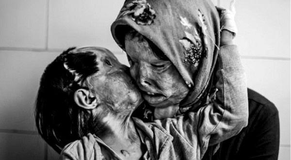 somayeh H δύναμη της αγάπης ενός γονιού για το παιδί του, μετά από επίθεση με οξύ επειδή ζήτησε διαζύγιο