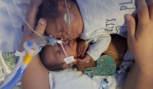 Γεννήθηκε πρόωρα, κινδύνευσε να πεθάνει αλλά τον έσωσε η αγκαλιά του δίδυμου αδερφού του! Διαβάστε την ιστορία