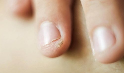 Τι είναι οι μυρμηγκιές στα παιδιά και πως αντιμετωπίζονται;
