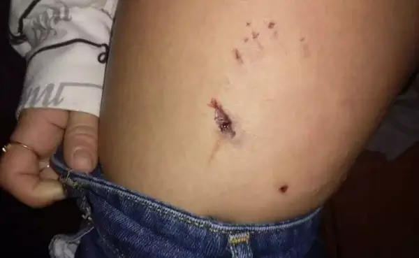 Αδέσποτος σκύλος δάγκωσε 14χρονη στο πόδι στη Χαλκιδική (φωτό)