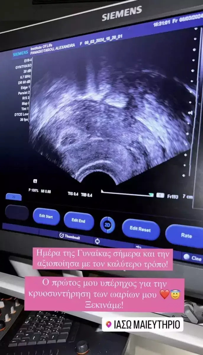 Αλεξάνδρα Παναγιώταρου: Ξεκίνησε τη διαδικασία για την κρυοσυντήρηση ωαρίων
